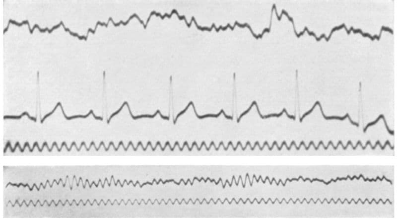 The first human EEG